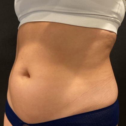 Liposuction Before & After Patient #13822