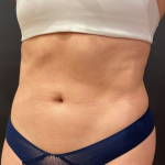 Liposuction Before & After Patient #13822